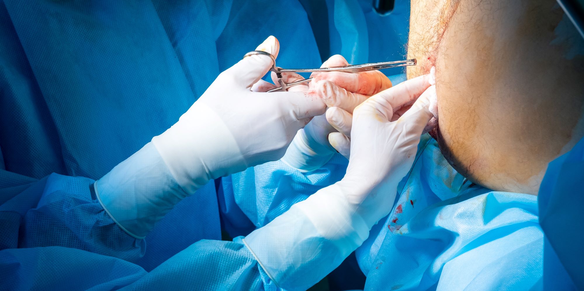 Procotolgy Proctology – Surgery | LUMICS
